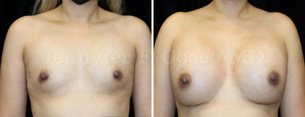Breast Augmentation - Jennyfer F Cocco, MD