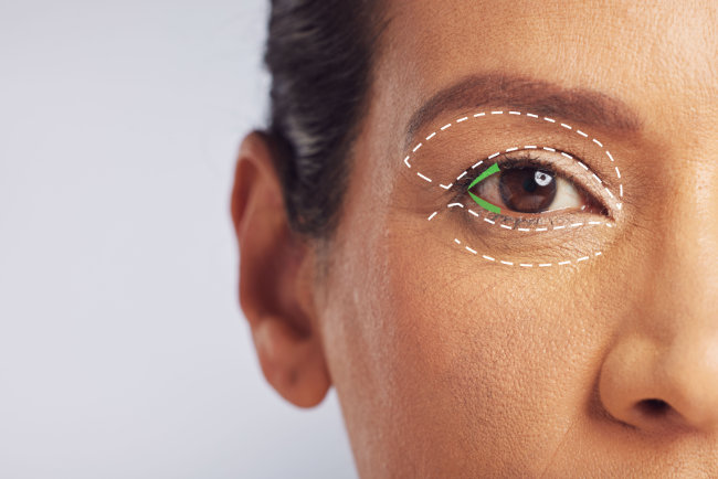 Blefaroplastia de Revision en Dallas, TX - Cirugia Secundaria de Parpados