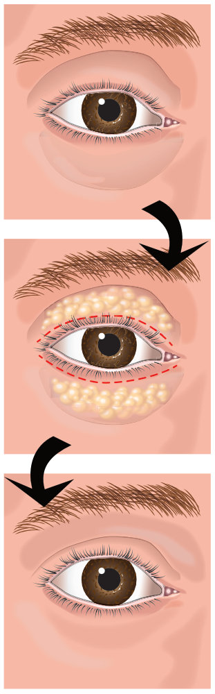 Blefaroplastia Combinada Superior e Inferior - Cirugia de Parpados