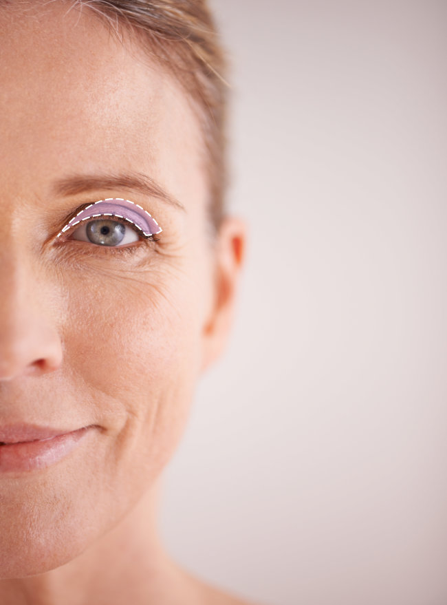 Blefaroplastia superior en Dallas, TX