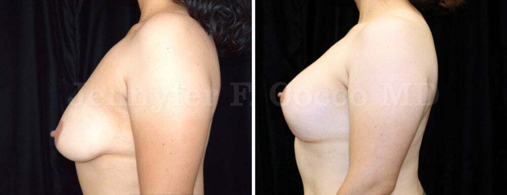 Breast Augmentation Mastopexy - Levantamiento de Senos con Implantes - Jennyfer F Cocco, MD - Plastic Surgery