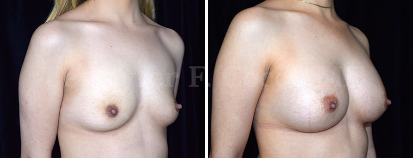 Breast Augmentation / Aumento de Senos - Jennyfer F. Cocco MD Plastic Surgery