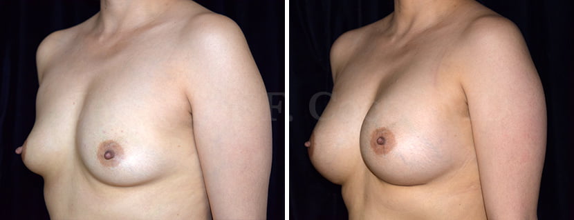 Breast Augmentation / Aumento de Senos - Jennyfer F. Cocco MD Plastic Surgery