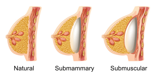 Breast Implant Placement