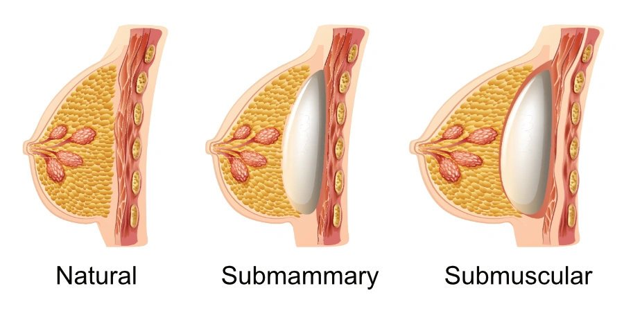 Breast Implant Placement