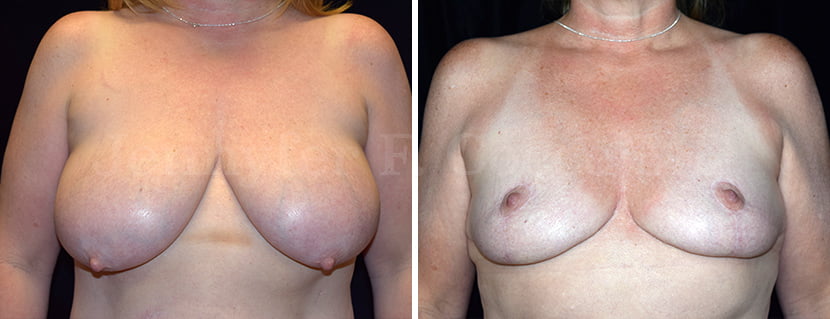 Breast Lift / Reduction | Levantamiento de Senos / Reducción - Jennyfer F. Cocco MD Plastic Surgery