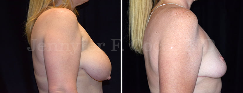 Breast Lift / Reduction | Levantamiento de Senos / Reducción - Jennyfer F. Cocco MD Plastic Surgery