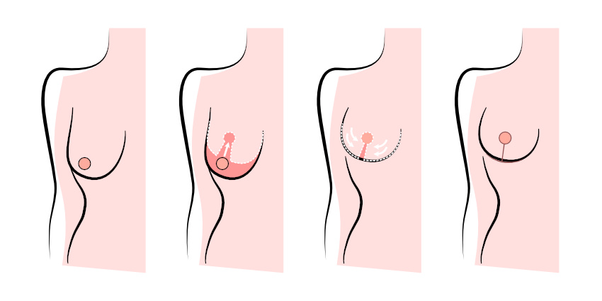 How the Breast Lift is Done