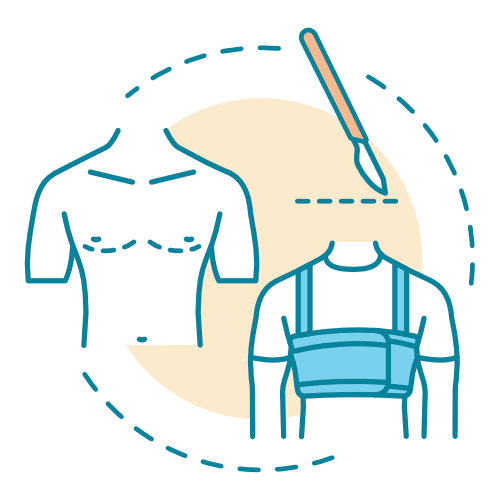 Breast Reduction for Men - Gynecomastia Breast Reduction for Men - Gynecomastia
