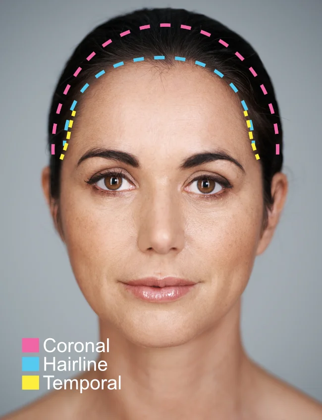 Different types of brow lift incisions