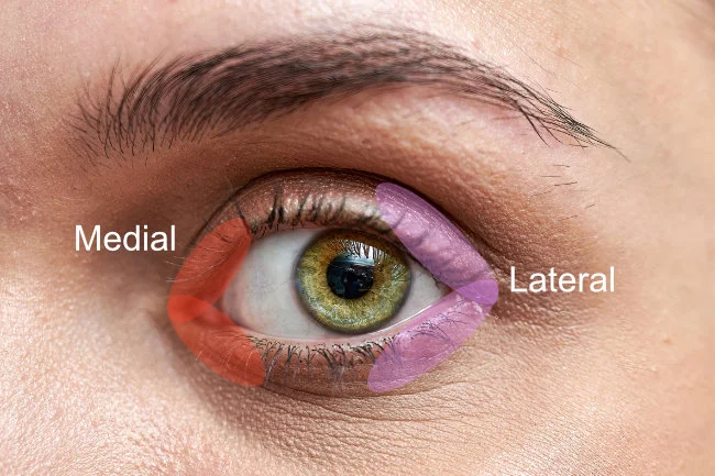 Cantopexia Medial y Lateral - Areas de tratamiento
