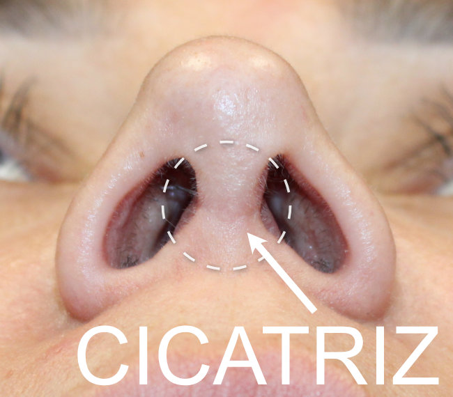 Cicatriz de Rinoplastia Abierta en Dallas, TX
