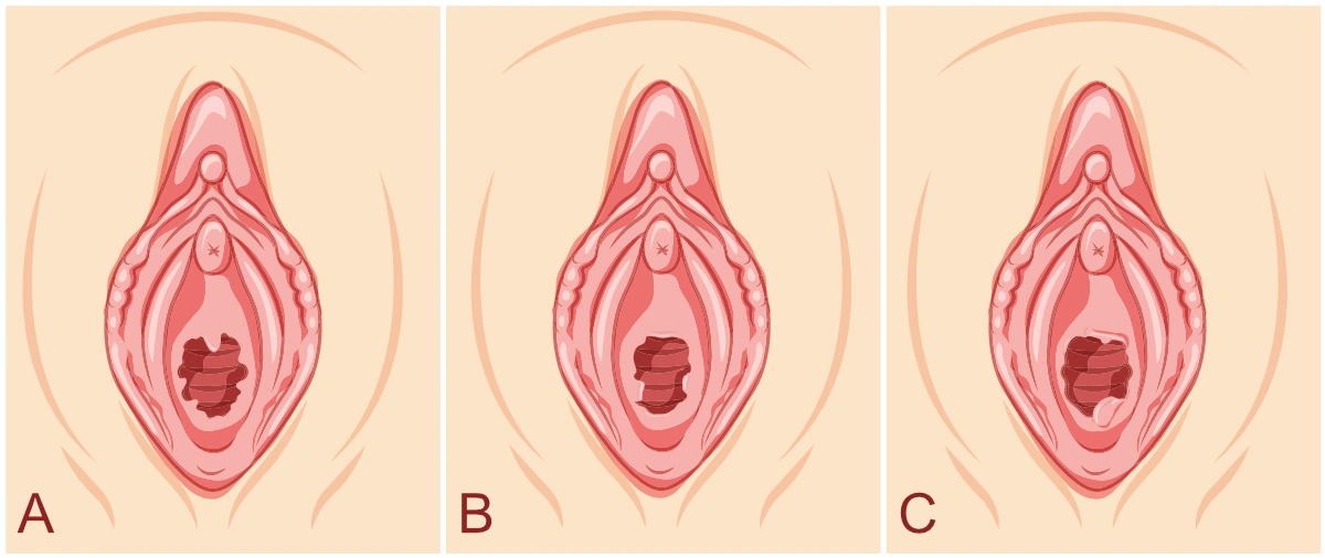 Common Types of Hymenal Remnants (Hymenal Caruncles) Medical illustration showing three common presentations of hymenal remnants: regular hymenal caruncles around the vaginal opening, fibrotic or hardened remnant tissue, and prolapsed hymenal tags extending outside the vaginal opening.