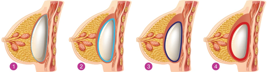 Contractura Capsular - Grados 1 a 4
