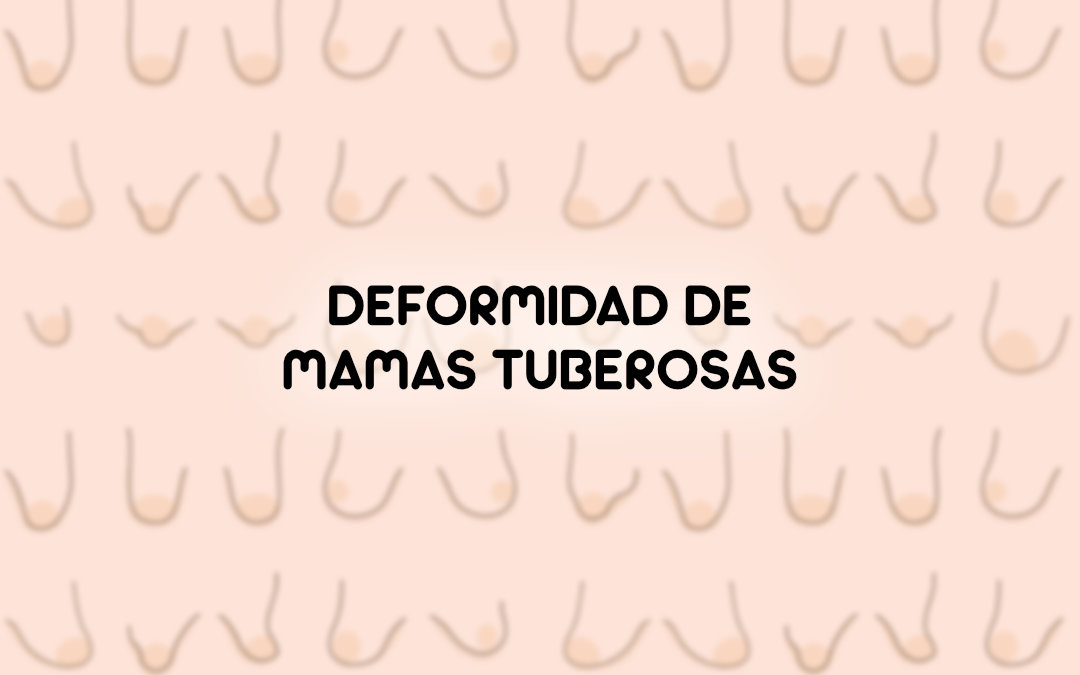 Deformidad de Mamas Tuberosas- Causas y Tratamiento - Portada