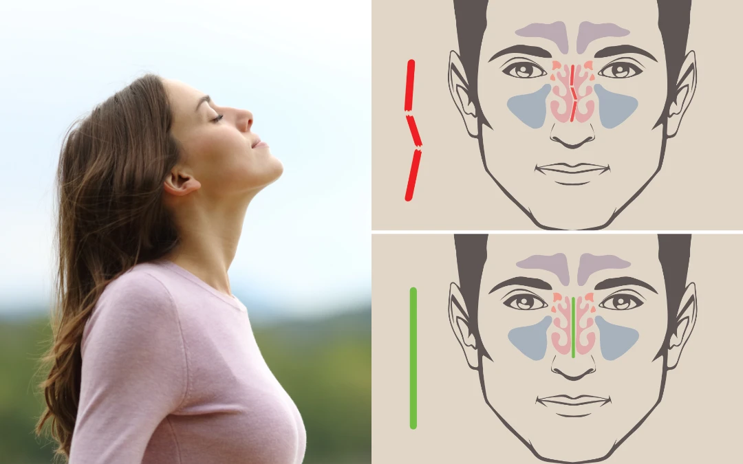 Diferentes tipos de cirugía nasal para respirar mejor - Portada