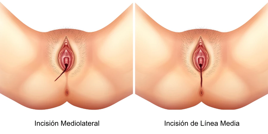 Incisiones de Episiotomía