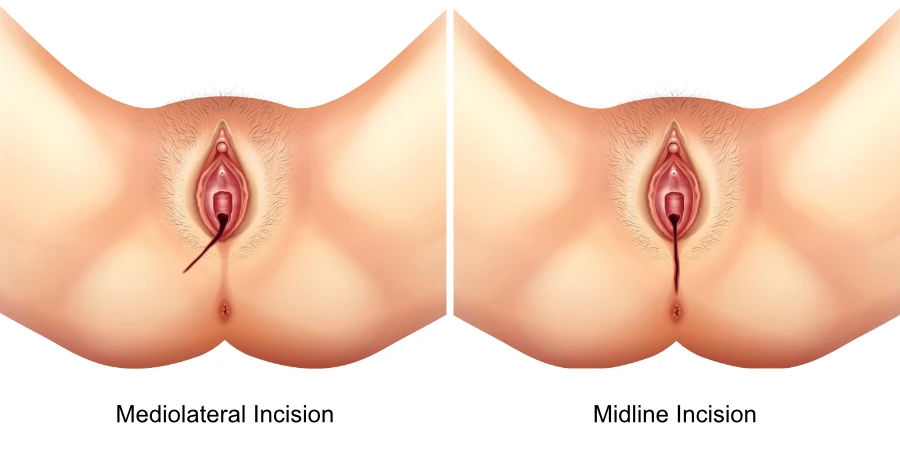Episiotomy Scar Revision in Dallas, TX