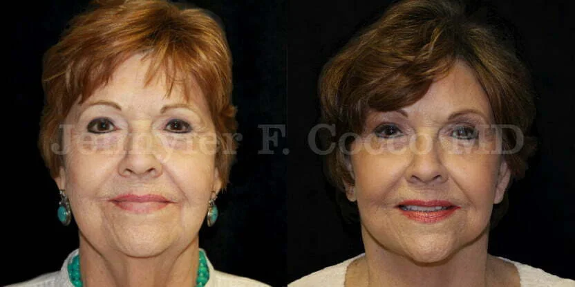 Facelift in Dallas, TX - Case A - Frontal View