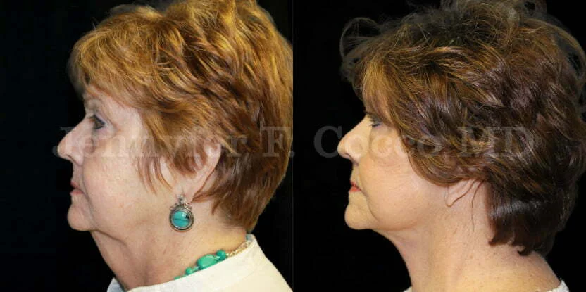 Facelift in Dallas, TX - Case A - Left Side