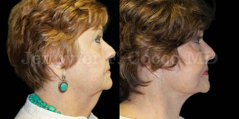 Facelift in Dallas, TX - Case A - Right Side