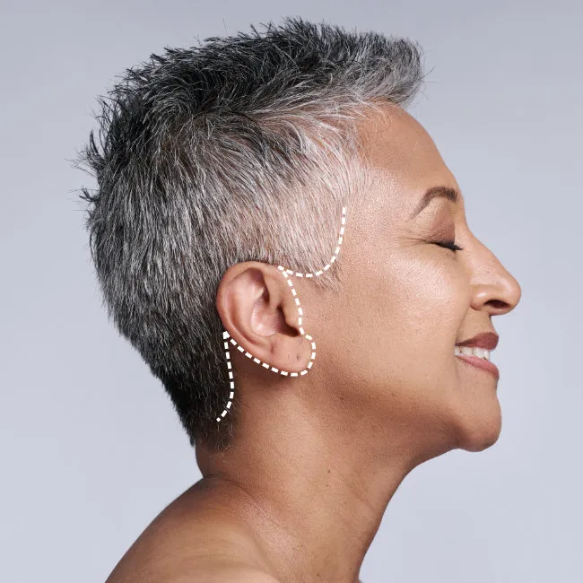 Facelift scar locations Facelift scar locations
