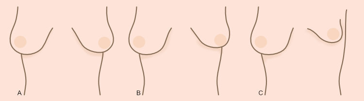 Grados de Asimetria de Mamas Tuberosas