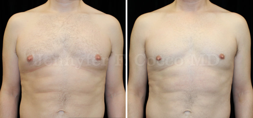 Gynecomastia Surgery in Dallas, TX - Case A - Frontal View