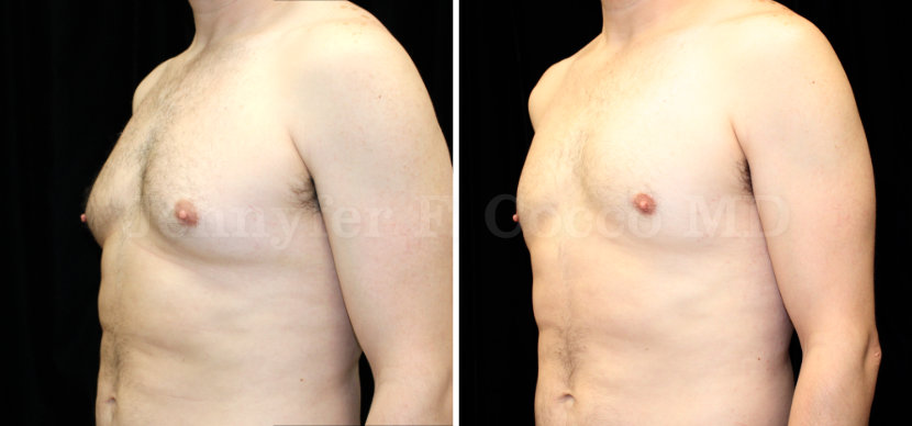 Gynecomastia Surgery in Dallas, TX - Case A - Oblique Left