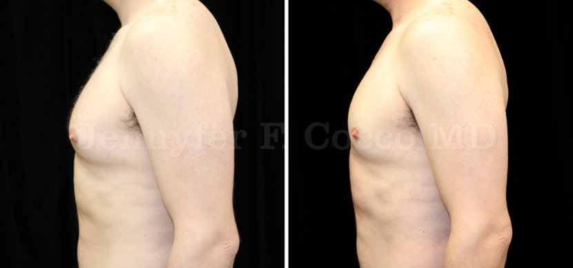 Gynecomastia Surgery in Dallas, TX - Case A - Left