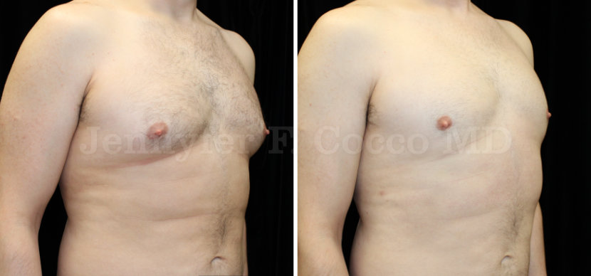 Gynecomastia Surgery in Dallas, TX - Case A - Oblique Right