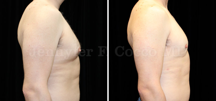 Gynecomastia Surgery in Dallas, TX - Case A - Right