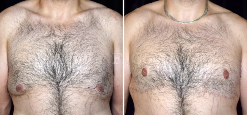 Gynecomastia Surgery in Dallas, TX - Case B - Front