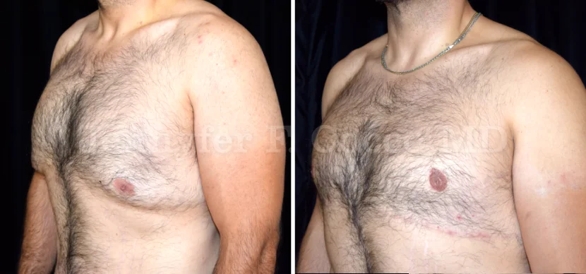 Gynecomastia Surgery in Dallas, TX - Case B - Left Oblique