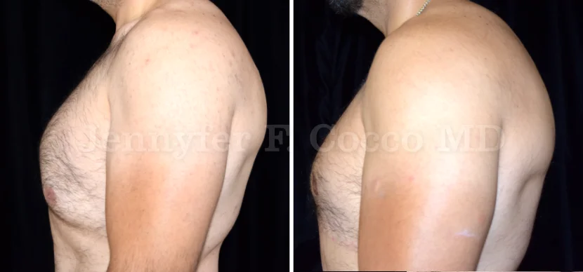 Gynecomastia Surgery in Dallas, TX - Case B - Left View