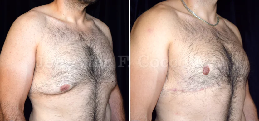 Gynecomastia Surgery in Dallas, TX - Case B - Right Oblique