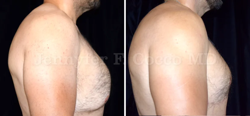 Gynecomastia Surgery in Dallas, TX - Case B - Right View