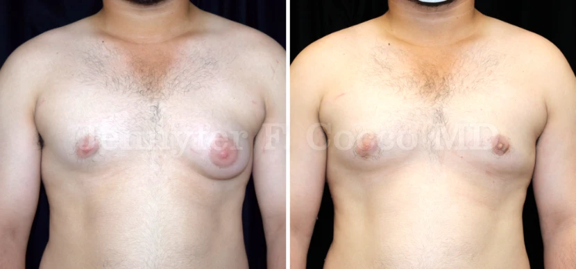 Gynecomastia Surgery in Dallas, TX - Case C - Front