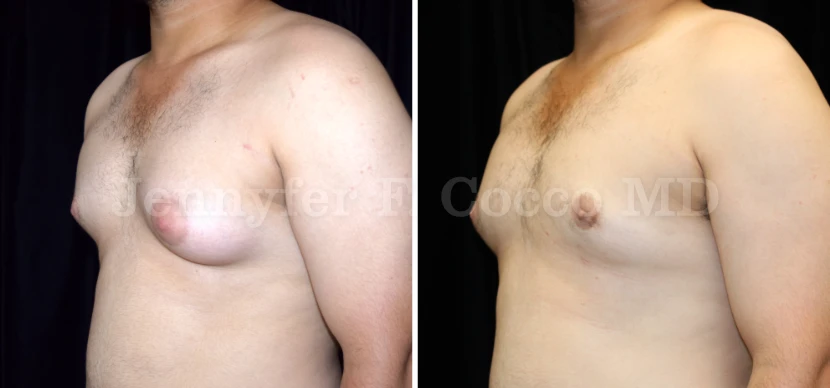 Gynecomastia Surgery in Dallas, TX - Case C - Left Oblique