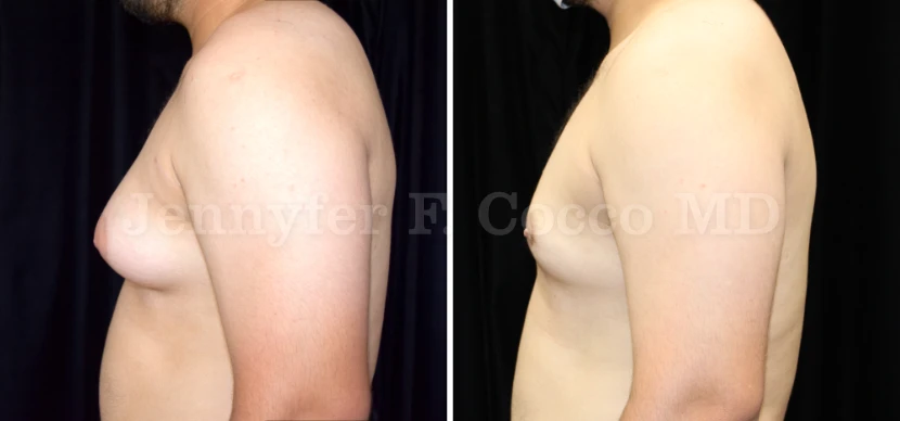 Gynecomastia Surgery in Dallas, TX - Case C - Left View