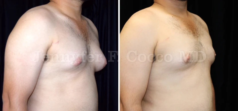 Gynecomastia Surgery in Dallas, TX - Case C - Right Oblique