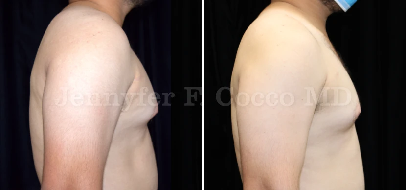 Gynecomastia Surgery in Dallas, TX - Case C - Right View