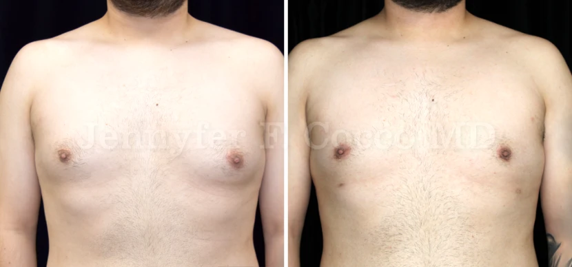 Gynecomastia in Dallas, TX - Case D - Front