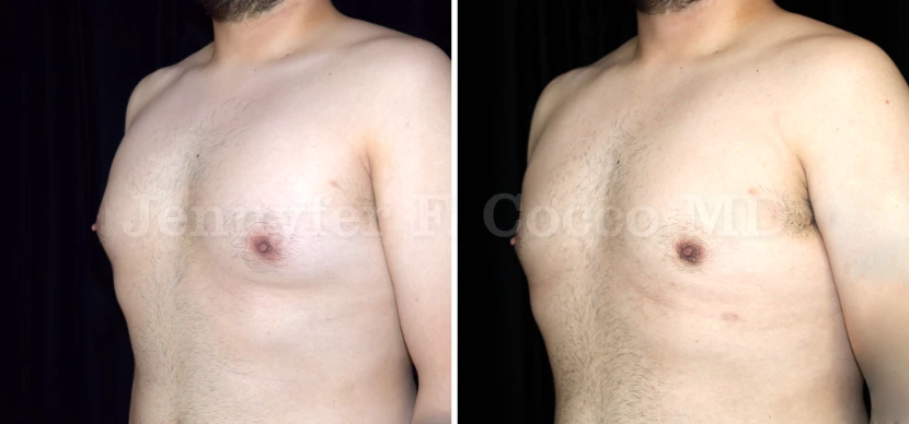 Gynecomastia in Dallas, TX - Case D - Left Oblique