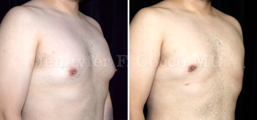 Gynecomastia in Dallas, TX - Case D - Right Oblique
