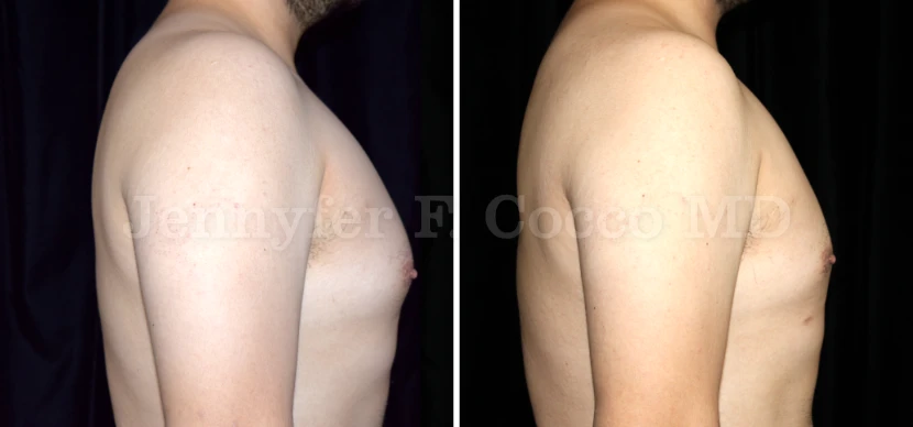 Gynecomastia in Dallas, TX - Case D - Right View