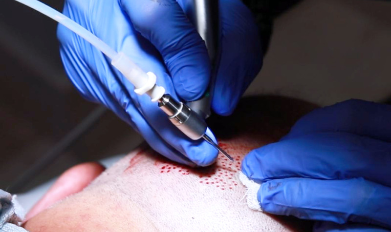 Herramienta de perforación FUE de SmartGraft