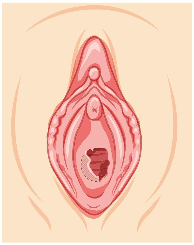 Partially Intact Hymenal Tissue Following an Incomplete Tear Medical illustration showing partially intact hymenal tissue remaining at the vaginal opening following an incomplete hymenal tear, with a dotted outline indicating how the remaining tissue can affect the normal outflow of menstrual blood and vaginal secretions.