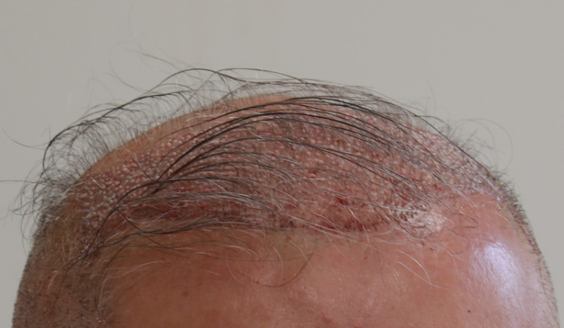 Injertos de Pelo Implantados