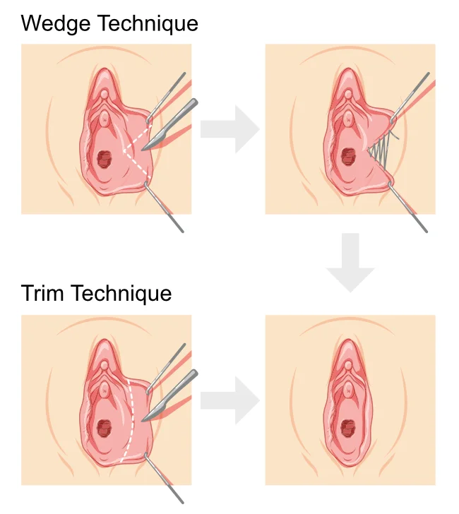 Labiaplasty Techniques - Trim and Wedge